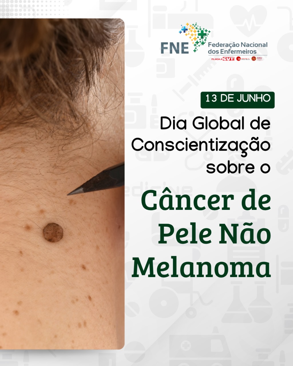 13/06 - Dia Global de Conscientização sobre o Câncer de Pele Não Melanoma